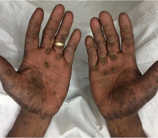 Understanding Lichenification Dermatitis vs Actinic Dermatitis: Key Differences and Comparisons